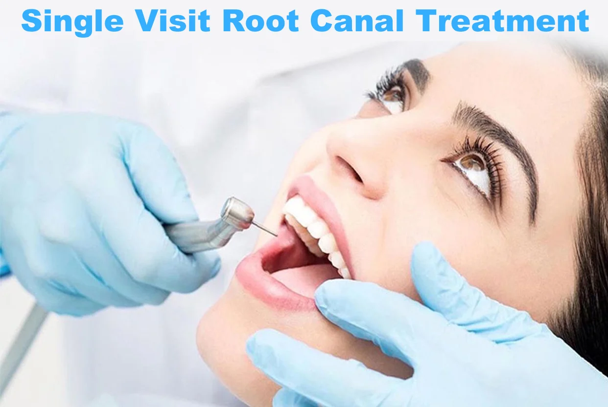 Painless Single Visit Root Canal Treatment