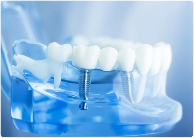 Dental Implants