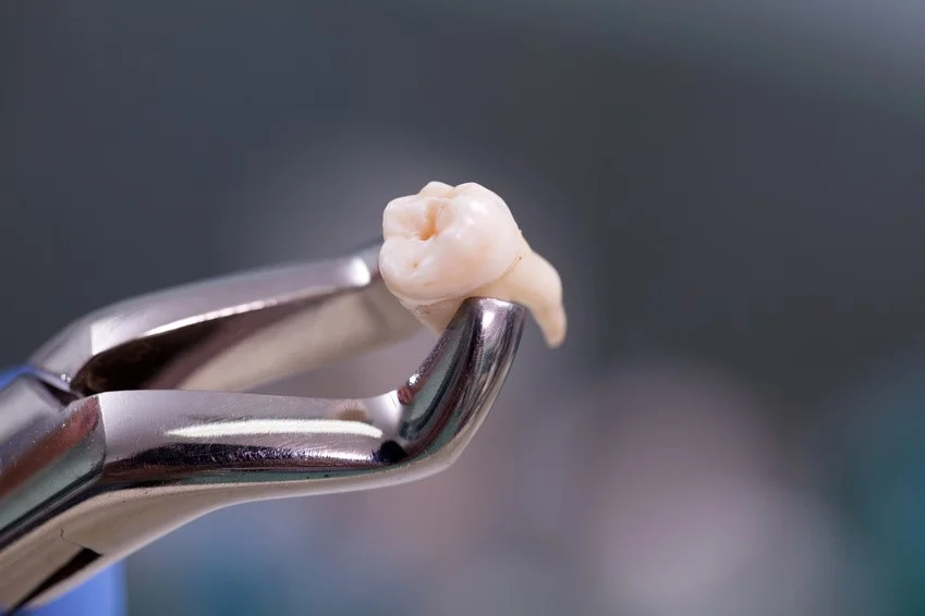 Wisdom Tooth Removal