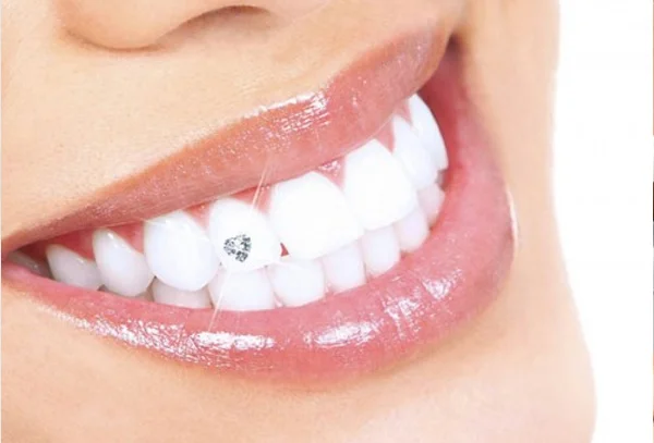 Dental Jewellery